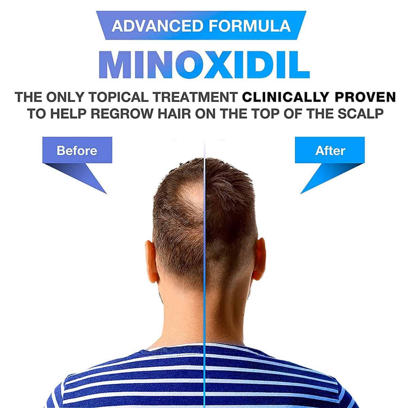 Minoxidil 5% Espuma Kirkland Caja X6 Foam Hair Regrowth
